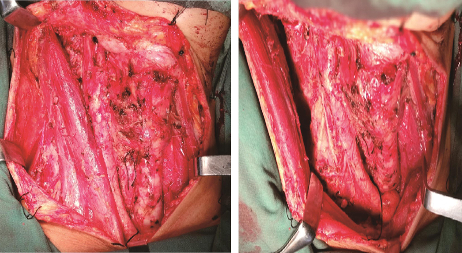 图9 甲状腺右叶、右侧颈部Ⅵ区淋巴脂肪组织、受累的右侧带状肌、皮肤一并切除后